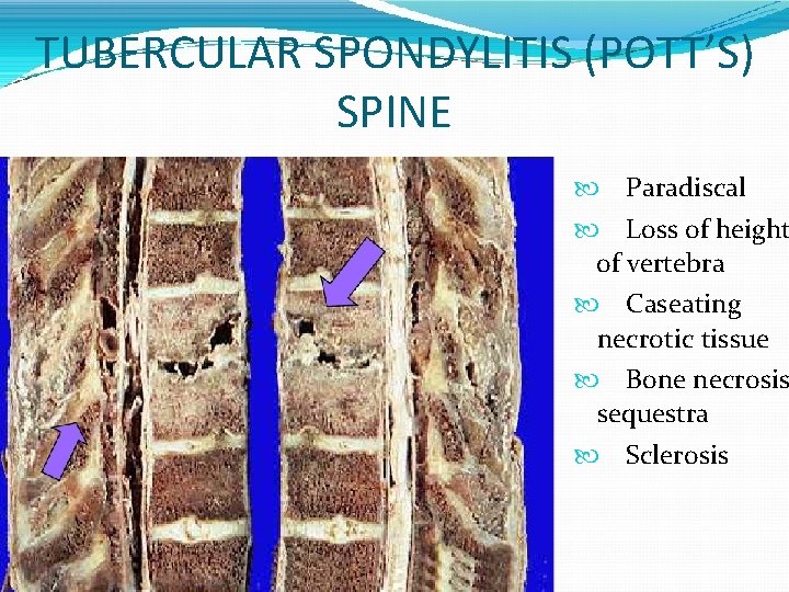 TUBERCULAR SPONDYLITIS (POTT’S) SPINE Paradiscal Loss of height of vertebra Caseating necrotic tissue Bone