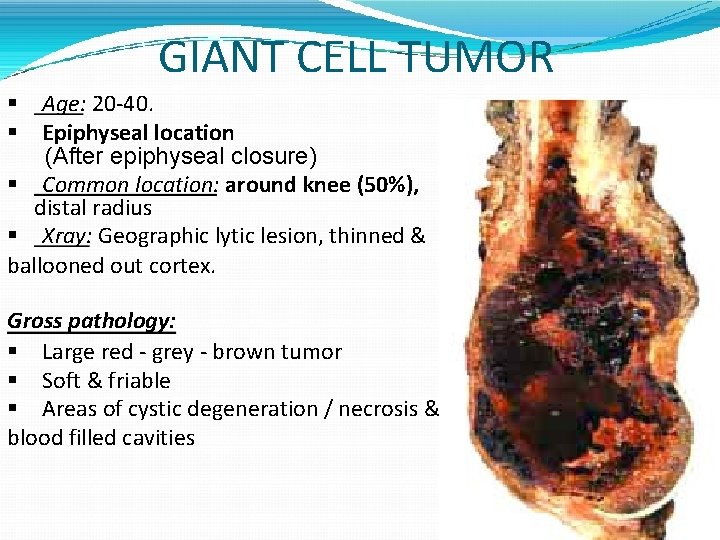 GIANT CELL TUMOR Age: 20 -40. Epiphyseal location (After epiphyseal closure) Common location: around