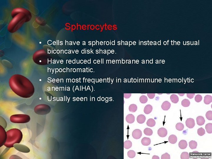 Spherocytes • Cells have a spheroid shape instead of the usual biconcave disk shape.