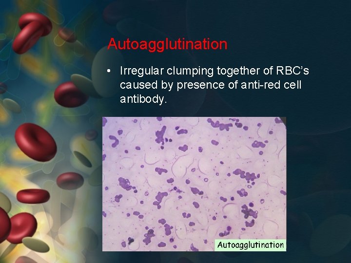 Autoagglutination • Irregular clumping together of RBC’s caused by presence of anti-red cell antibody.