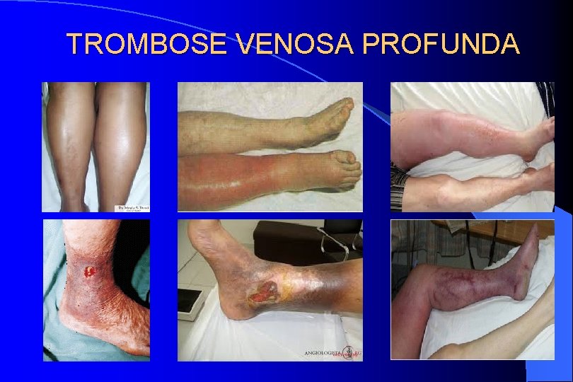 TROMBOSE VENOSA PROFUNDA 