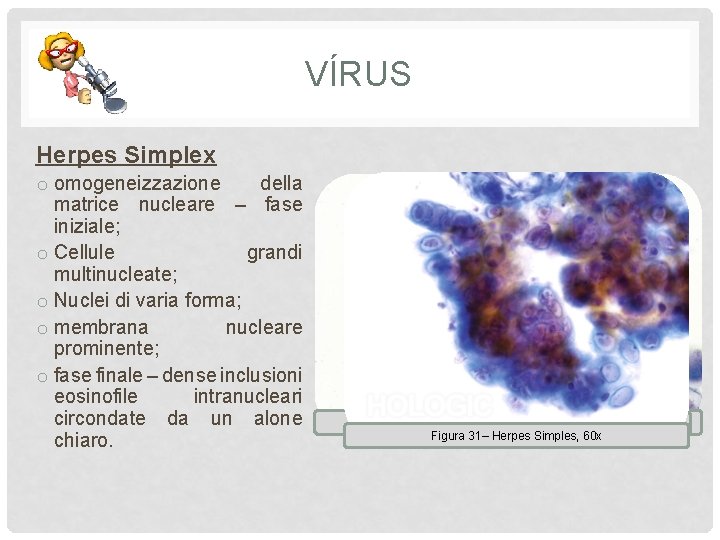 VÍRUS Herpes Simplex o omogeneizzazione della matrice nucleare – fase iniziale; o Cellule grandi