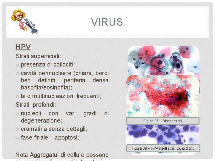 VIRUS HPV Strati superficiali: o presenza di coilociti; o cavità perinucleare (chiara, bordi ben