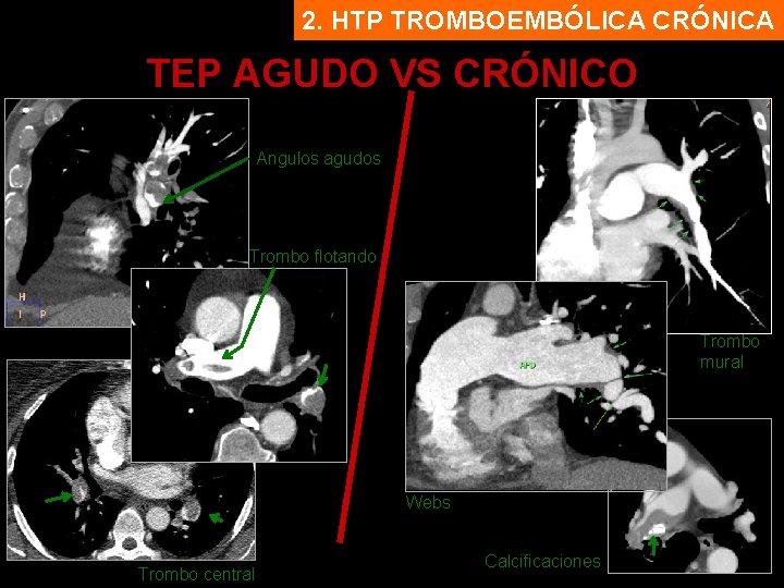 2. HTP TROMBOEMBÓLICA CRÓNICA TEP AGUDO VS CRÓNICO Angulos agudos Trombo flotando Trombo mural