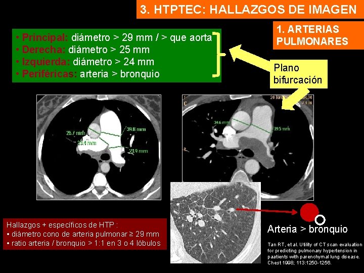 3. HTPTEC: HALLAZGOS DE IMAGEN • Principal: diámetro > 29 mm / > que