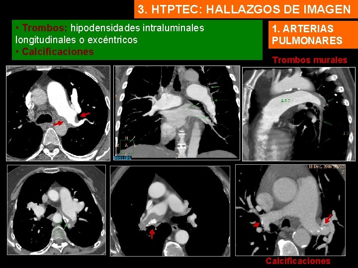 3. HTPTEC: HALLAZGOS DE IMAGEN • Trombos: hipodensidades intraluminales longitudinales o excéntricos • Calcificaciones