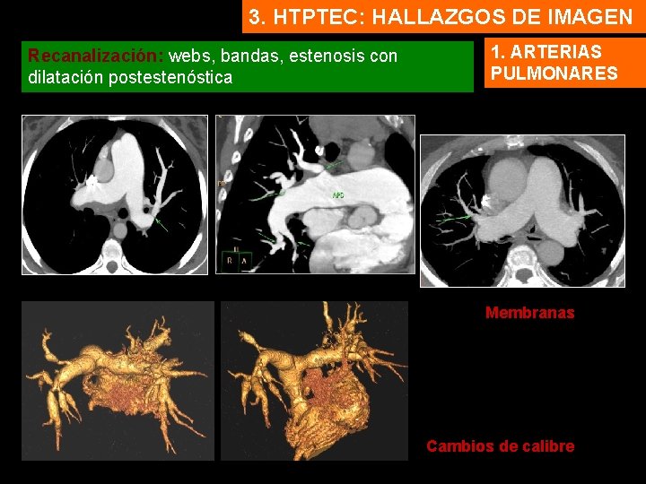 3. HTPTEC: HALLAZGOS DE IMAGEN Recanalización: webs, bandas, estenosis con dilatación postestenóstica 1. ARTERIAS