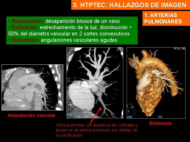 3. HTPTEC: HALLAZGOS DE IMAGEN • Amputación: desaparición brusca de un vaso • Estenosis: