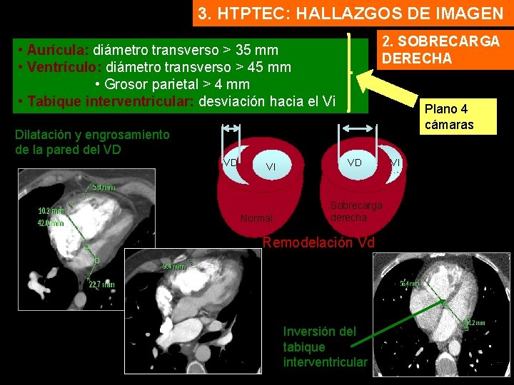 3. HTPTEC: HALLAZGOS DE IMAGEN 2. SOBRECARGA DERECHA • Aurícula: diámetro transverso > 35