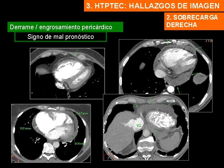 3. HTPTEC: HALLAZGOS DE IMAGEN Derrame / engrosamiento pericárdico Signo de mal pronóstico 2.