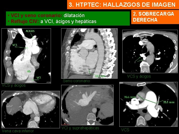 3. HTPTEC: HALLAZGOS DE IMAGEN 2. SOBRECARGA DERECHA • VCI y seno coronario: dilatación