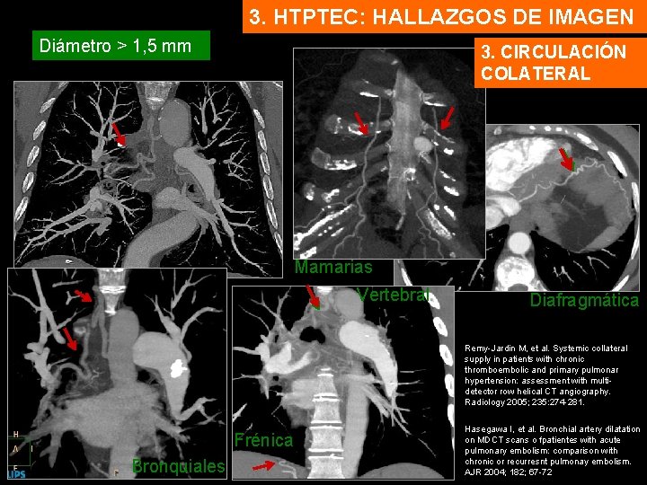 3. HTPTEC: HALLAZGOS DE IMAGEN Diámetro > 1, 5 mm 3. CIRCULACIÓN COLATERAL Mamarias