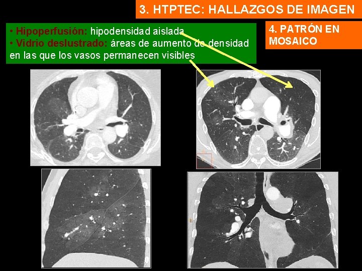 3. HTPTEC: HALLAZGOS DE IMAGEN • Hipoperfusión: hipodensidad aislada • Vidrio deslustrado: áreas de