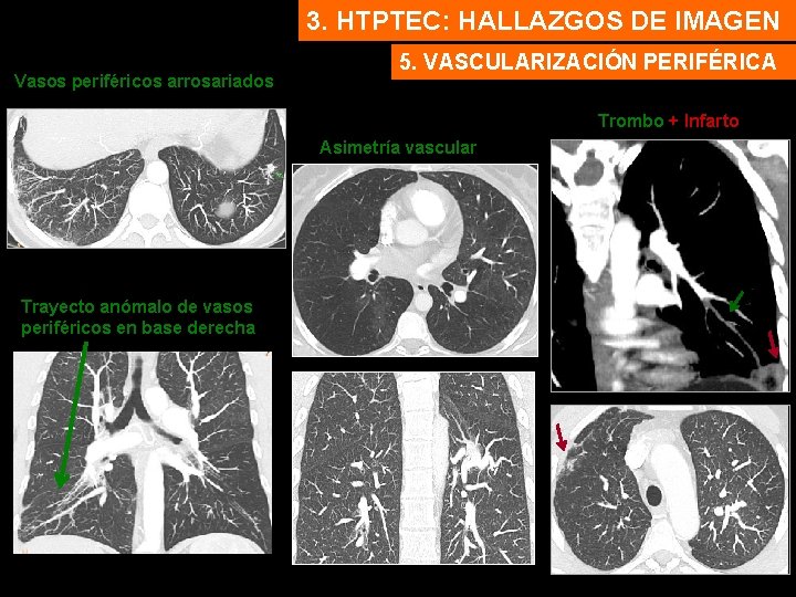 3. HTPTEC: HALLAZGOS DE IMAGEN Vasos periféricos arrosariados 5. VASCULARIZACIÓN PERIFÉRICA Trombo + Infarto