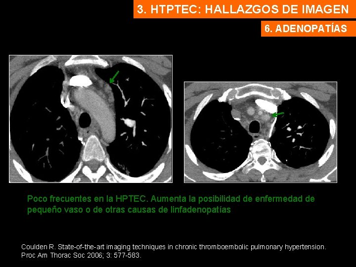 3. HTPTEC: HALLAZGOS DE IMAGEN 6. ADENOPATÍAS Poco frecuentes en la HPTEC. Aumenta la