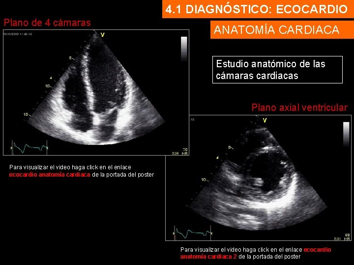 4. 1 DIAGNÓSTICO: ECOCARDIO Plano de 4 cámaras ANATOMÍA CARDIACA Estudio anatómico de las