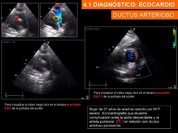 4. 1 DIAGNÓSTICO: ECOCARDIO DUCTUS ARTERIOSO Para visualizar el video haga click en el