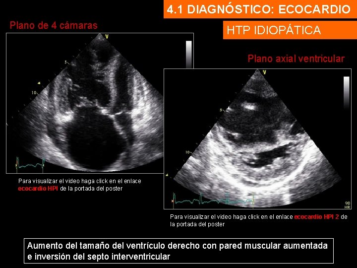 4. 1 DIAGNÓSTICO: ECOCARDIO Plano de 4 cámaras HTP IDIOPÁTICA Plano axial ventricular Para