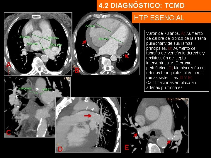 4. 2 DIAGNÓSTICO: TCMD HTP ESENCIAL A Varón de 70 años. A) Aumento de