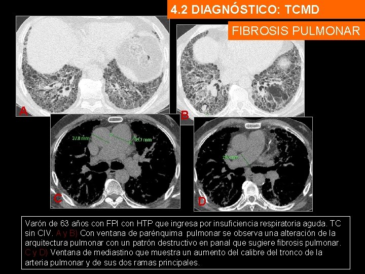 4. 2 DIAGNÓSTICO: TCMD FIBROSIS PULMONAR A B C D Varón de 63 años