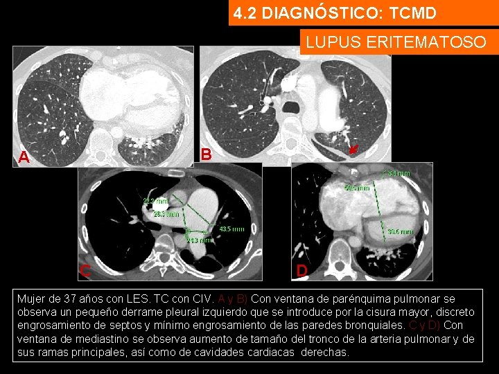 4. 2 DIAGNÓSTICO: TCMD LUPUS ERITEMATOSO B A C D Mujer de 37 años