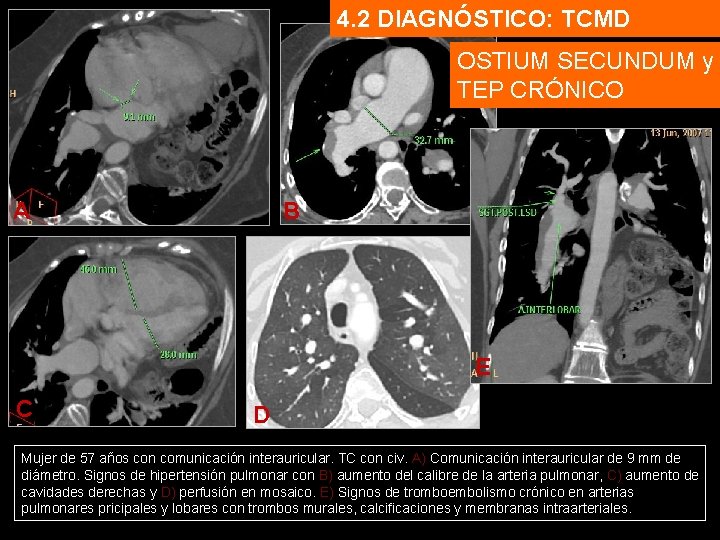 4. 2 DIAGNÓSTICO: TCMD OSTIUM SECUNDUM y TEP CRÓNICO A B E C D