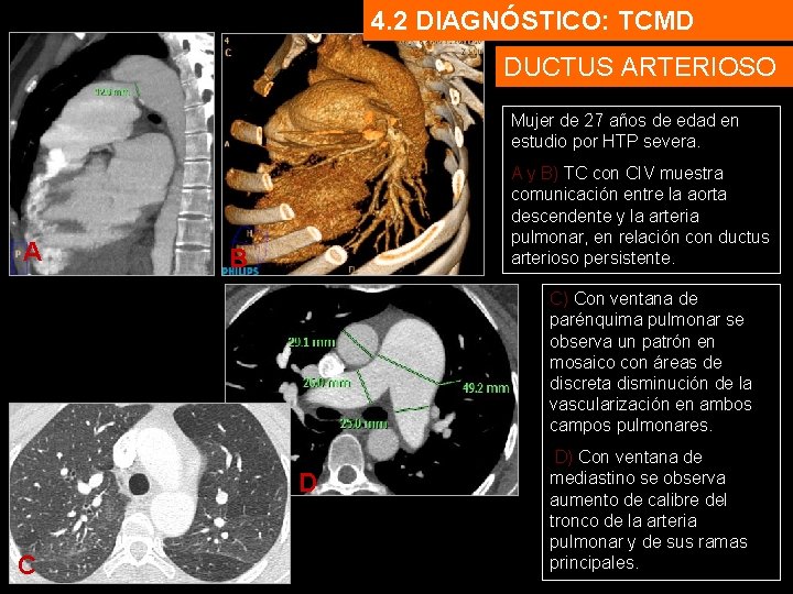 4. 2 DIAGNÓSTICO: TCMD DUCTUS ARTERIOSO Mujer de 27 años de edad en estudio