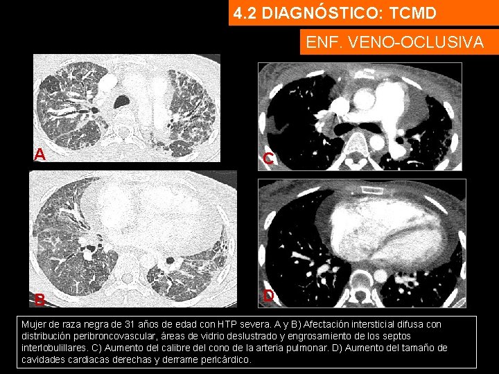 4. 2 DIAGNÓSTICO: TCMD ENF. VENO-OCLUSIVA A C B D Mujer de raza negra