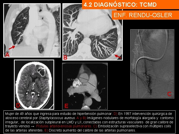4. 2 DIAGNÓSTICO: TCMD ENF. RENDU-OSLER A B C D E Mujer de 49