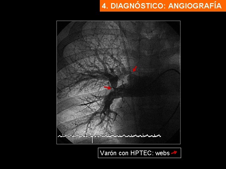 4. DIAGNÓSTICO: ANGIOGRAFÍA Varón con HPTEC: webs 