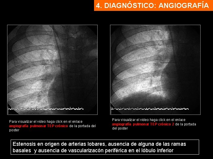 4. DIAGNÓSTICO: ANGIOGRAFÍA Para visualizar el video haga click en el enlace angiografía pulmonar
