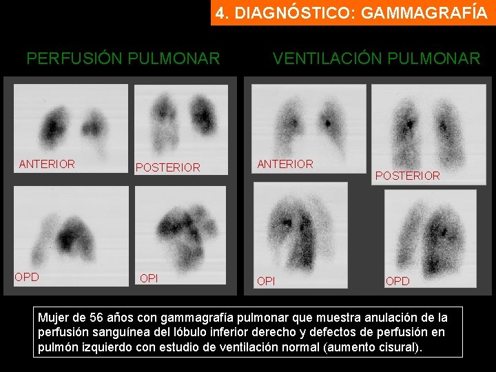4. DIAGNÓSTICO: GAMMAGRAFÍA PERFUSIÓN PULMONAR ANTERIOR OPD POSTERIOR OPI VENTILACIÓN PULMONAR ANTERIOR OPI POSTERIOR