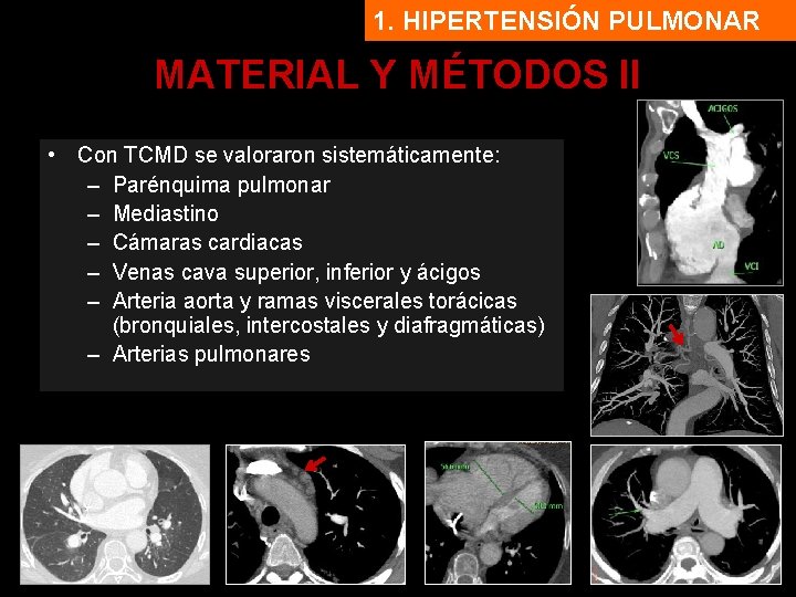 1. HIPERTENSIÓN PULMONAR MATERIAL Y MÉTODOS II • Con TCMD se valoraron sistemáticamente: –