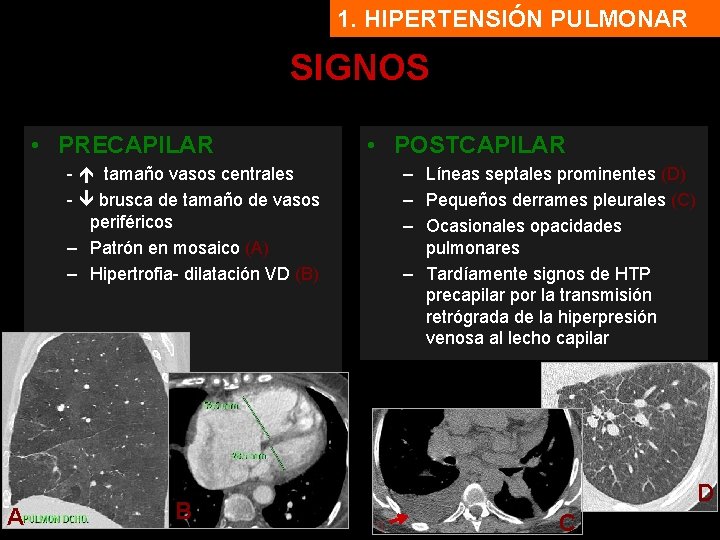 1. HIPERTENSIÓN PULMONAR SIGNOS • PRECAPILAR - tamaño vasos centrales - brusca de tamaño