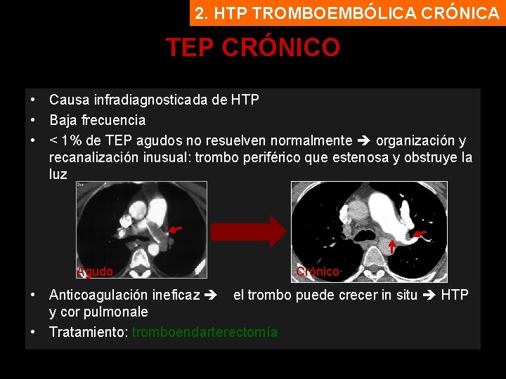 2. HTP TROMBOEMBÓLICA CRÓNICA TEP CRÓNICO • Causa infradiagnosticada de HTP • Baja frecuencia