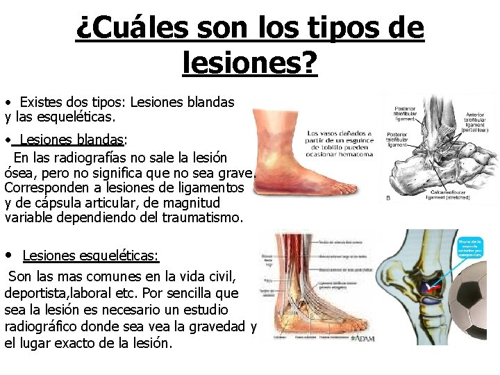 ¿Cuáles son los tipos de lesiones? • Existes dos tipos: Lesiones blandas y las