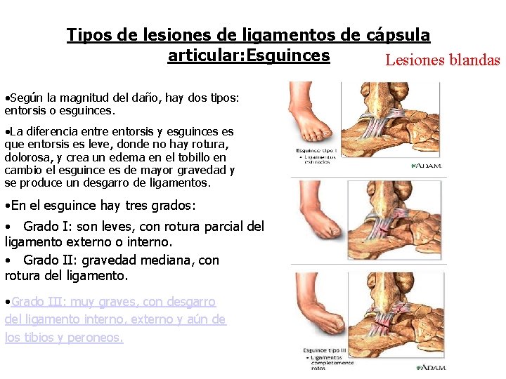 Tipos de lesiones de ligamentos de cápsula articular: Esguinces Lesiones blandas • Según la