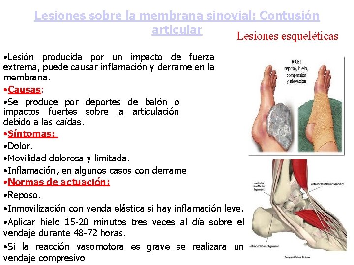 Lesiones sobre la membrana sinovial: Contusión articular Lesiones esqueléticas • Lesión producida por un