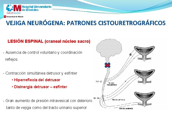 VEJIGA NEURÓGENA: PATRONES CISTOURETROGRÁFICOS LESIÓN ESPINAL (craneal núcleo sacro) - Ausencia de control voluntario