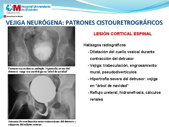VEJIGA NEURÓGENA: PATRONES CISTOURETROGRÁFICOS LESIÓN CORTICAL ESPINAL Hallazgos radiográficos - Dilatación del cuello vesical