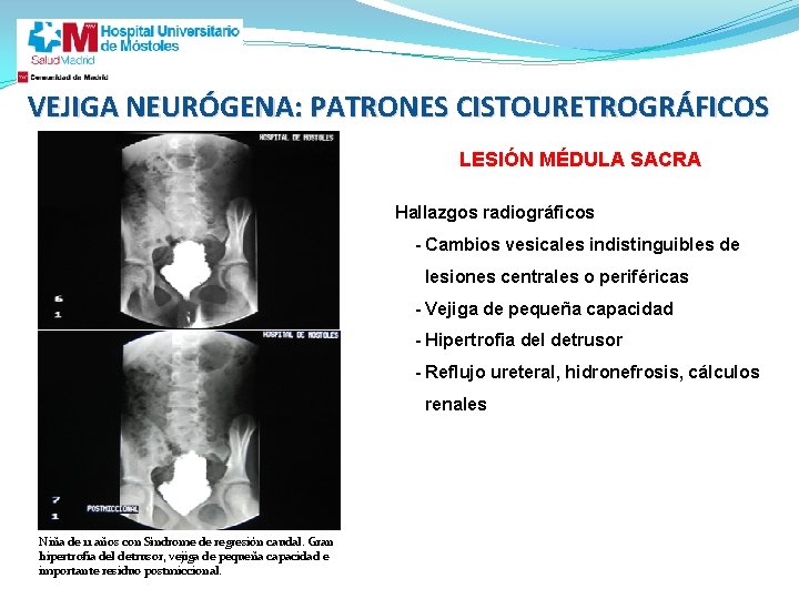 VEJIGA NEURÓGENA: PATRONES CISTOURETROGRÁFICOS LESIÓN MÉDULA SACRA Hallazgos radiográficos - Cambios vesicales indistinguibles de