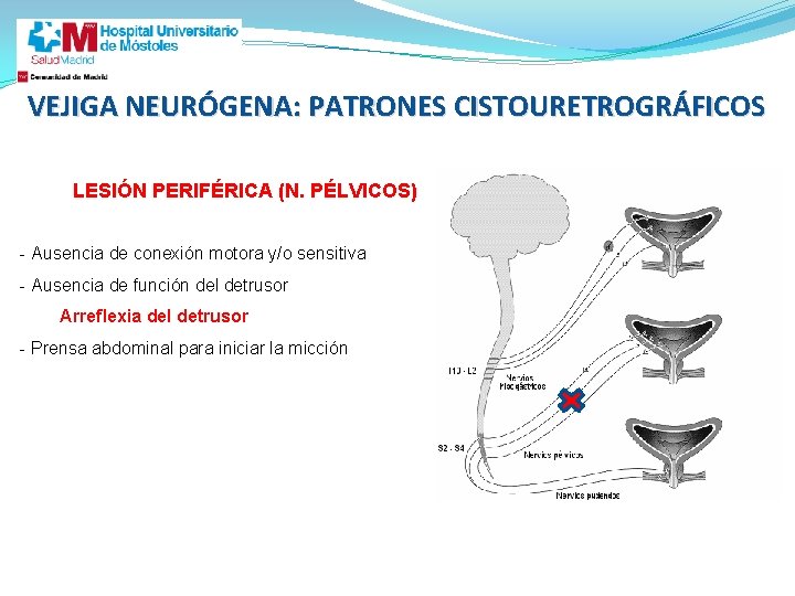 VEJIGA NEURÓGENA: PATRONES CISTOURETROGRÁFICOS LESIÓN PERIFÉRICA (N. PÉLVICOS) - Ausencia de conexión motora y/o