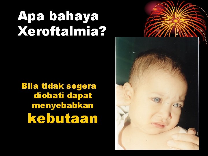 Apa bahaya Xeroftalmia? Bila tidak segera diobati dapat menyebabkan kebutaan 