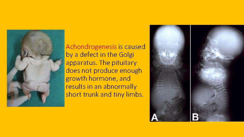 Achondrogenesis is caused by a defect in the Golgi apparatus. The pituitary does not