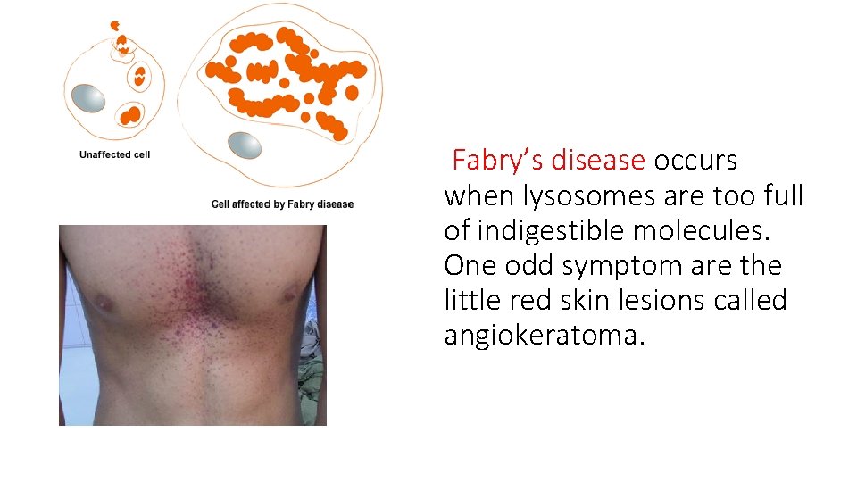 Fabry’s disease occurs when lysosomes are too full of indigestible molecules. One odd symptom
