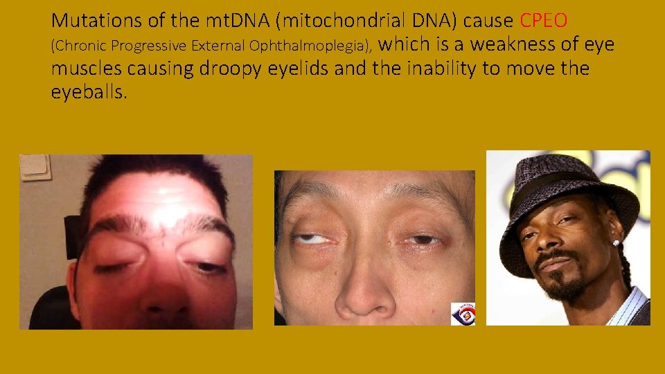 Mutations of the mt. DNA (mitochondrial DNA) cause CPEO (Chronic Progressive External Ophthalmoplegia), which