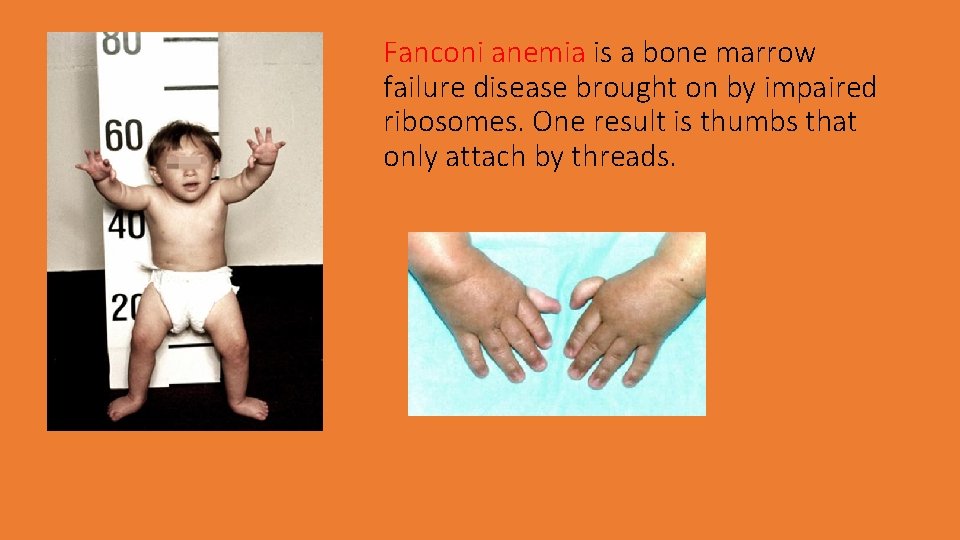 Fanconi anemia is a bone marrow failure disease brought on by impaired ribosomes. One
