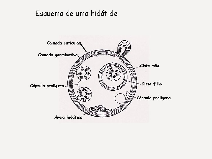 Esquema de uma hidátide Camada cuticular Camada germinativa Cisto mãe Cápsula prolígera Cisto filho