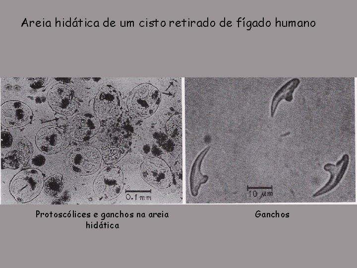 Areia hidática de um cisto retirado de fígado humano Protoscólices e ganchos na areia