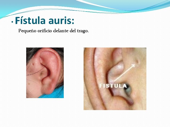  • Fístula auris: Pequeño orificio delante del trago. 
